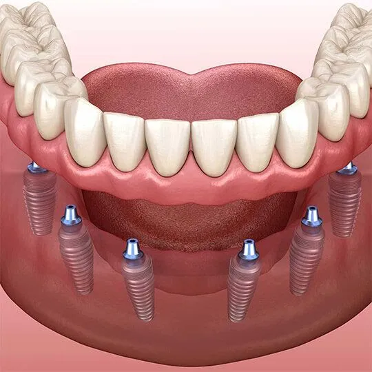 Top Implantologists in Dubai
