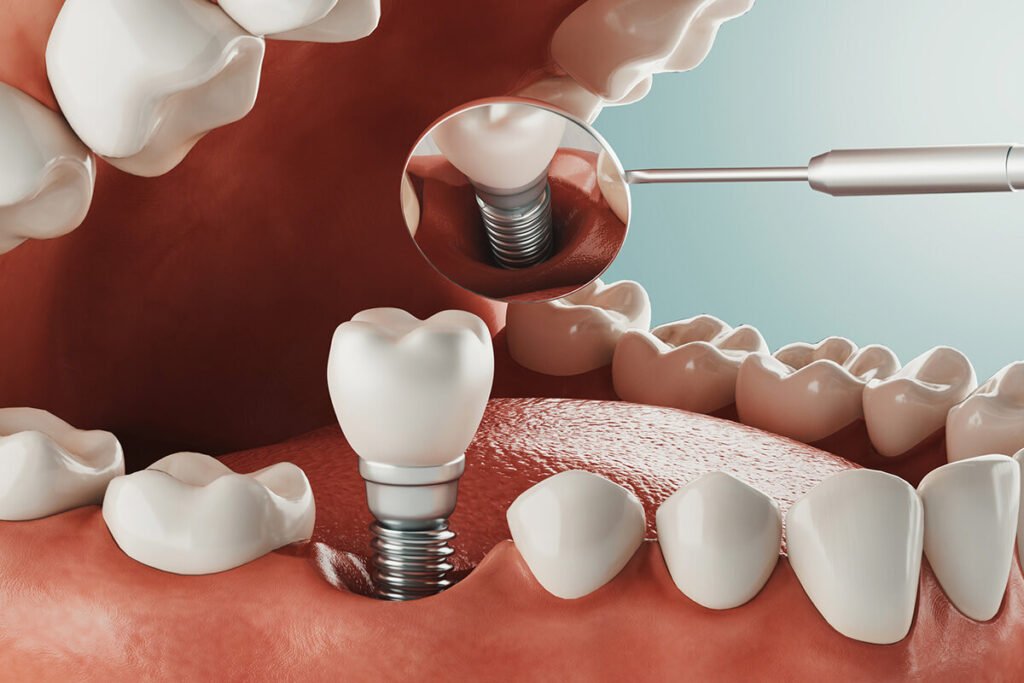 Same Day Dental Implants Dubai: Is It the Right Choice for You?