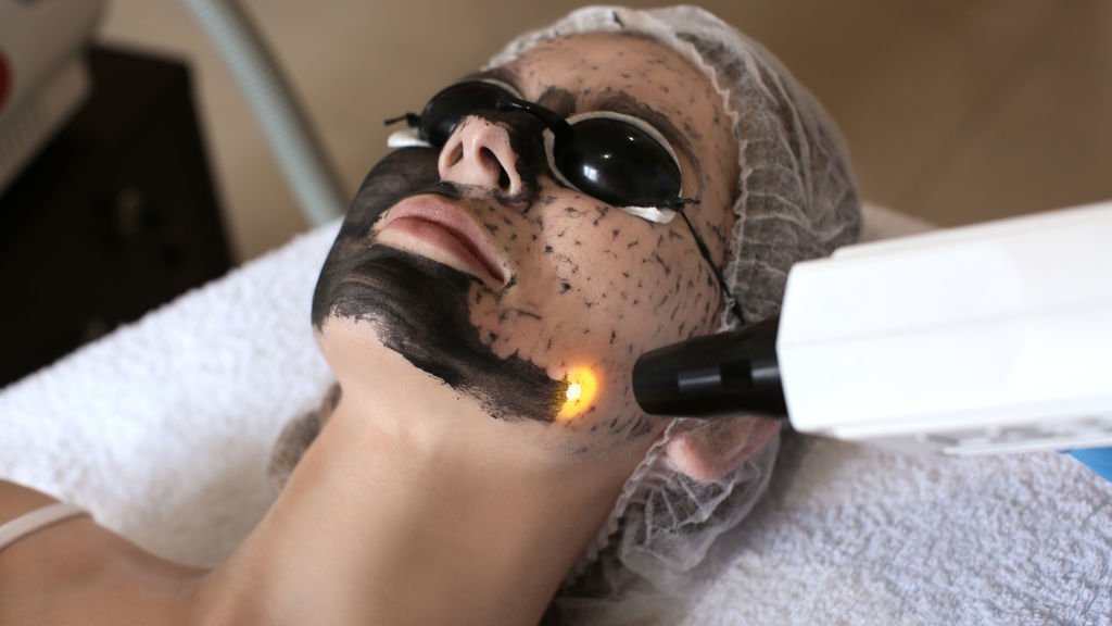 Carbon Laser Treatment