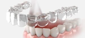 Best Cosmetic & Dental Clinic in Dubai Clear Aligners in dubai