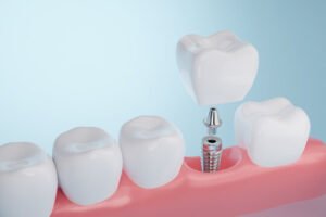 Best Cosmetic & Dental Clinic in Dubai Same Day Dental Implants Dubai